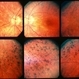 Retinitis Pigmentosa